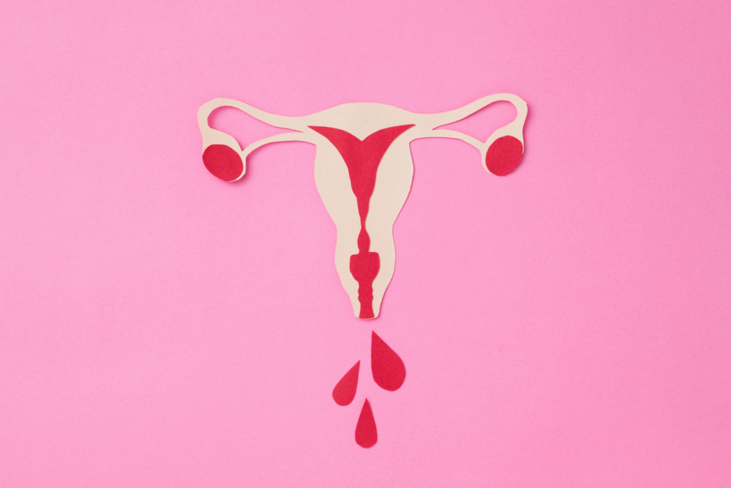 sopk cycles menstruels