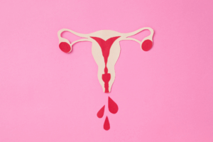 sopk cycles menstruels